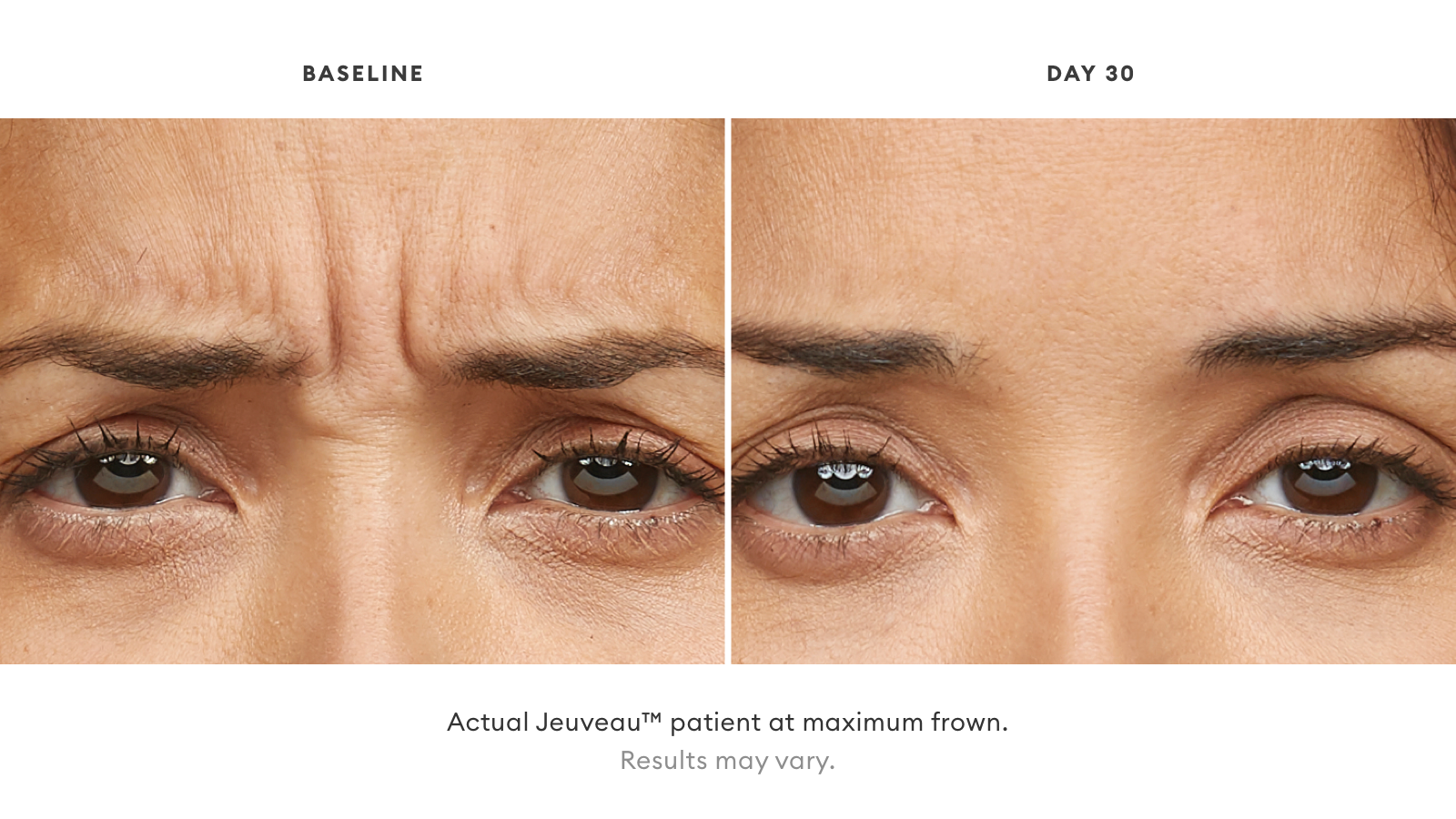 Jeuveau Newtox before and after