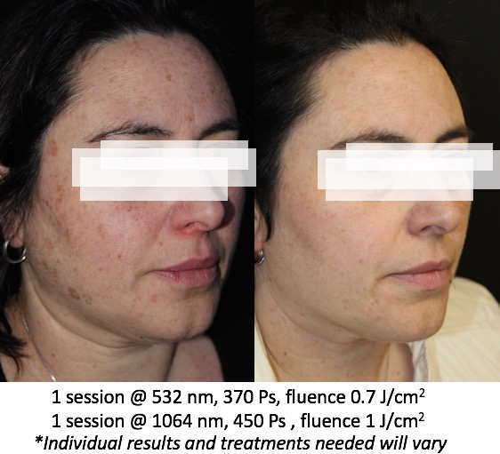 pico laser tattoo removal