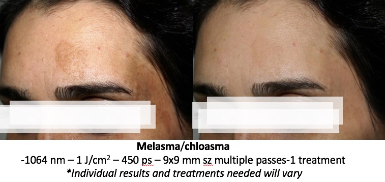 pico laser tattoo removal
