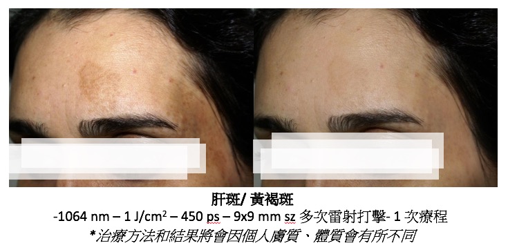 pico laser tattoo removal
