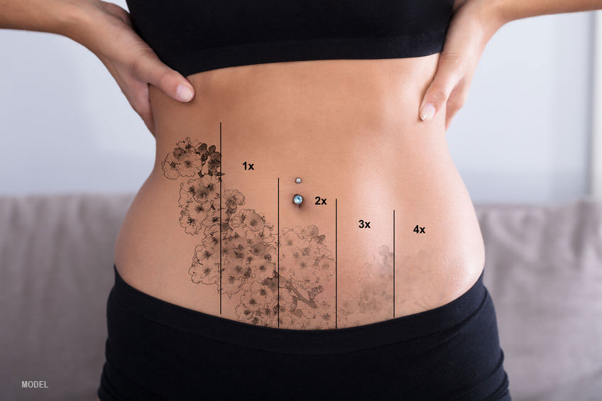 Pico Laser Tattoo Removal