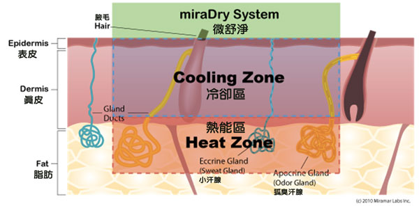 miraDry under the skin