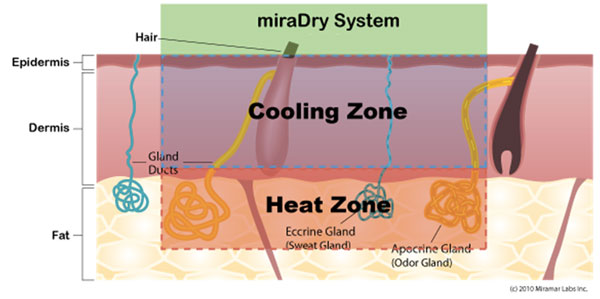 miraDry under the skin