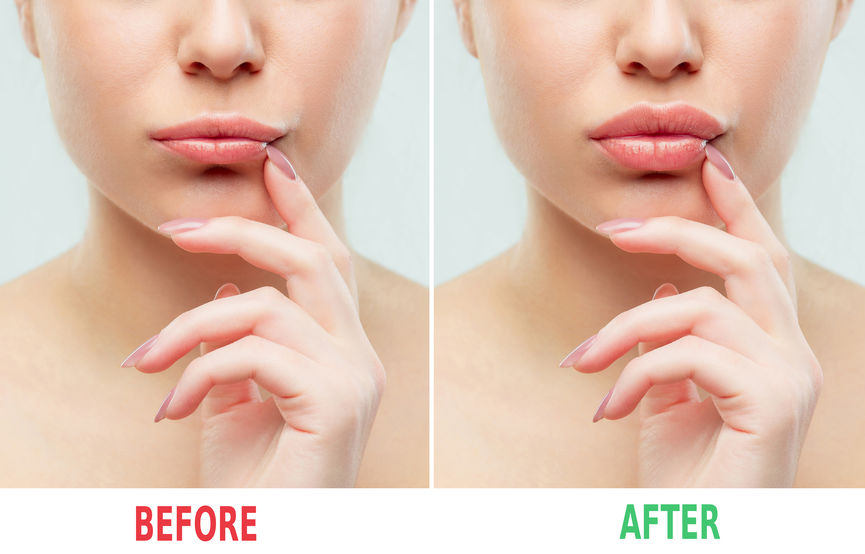 “Restylane