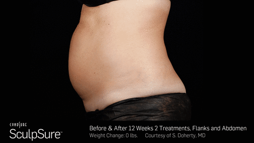 SculpSure™ Before and After Photos