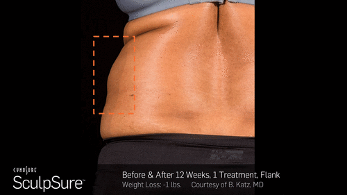 SculpSure™ Before and After Photos