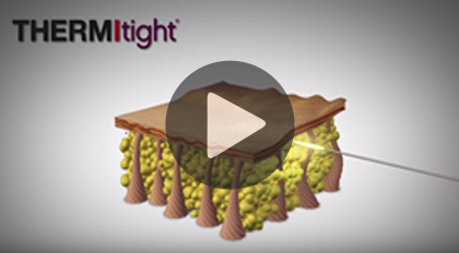 Video: Your Guide to ThermiTight